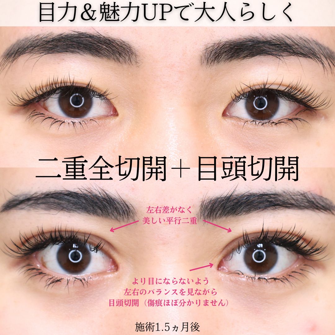 上眼瞼切開術/目頭切開術の症例写真 施術前後 