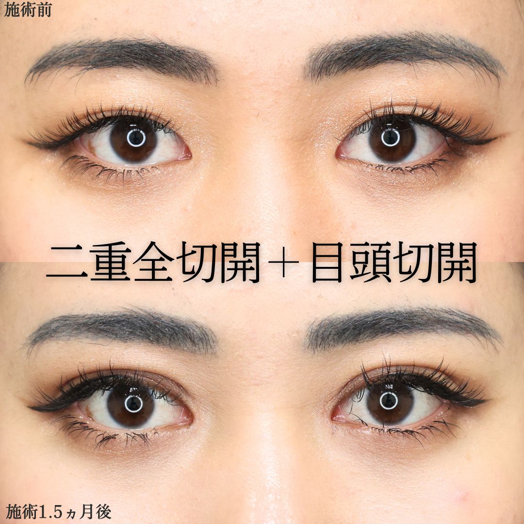 上眼瞼切開術/目頭切開術の症例写真 施術前後 