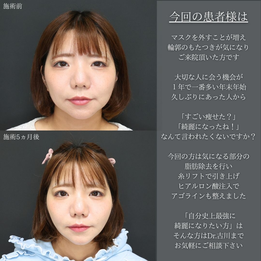 TAC式 ツヤ肌コラーゲンリフト®/ジョールファット除去/Lラインファット除去（エラ下脂肪除去）の症例写真 施術前後 