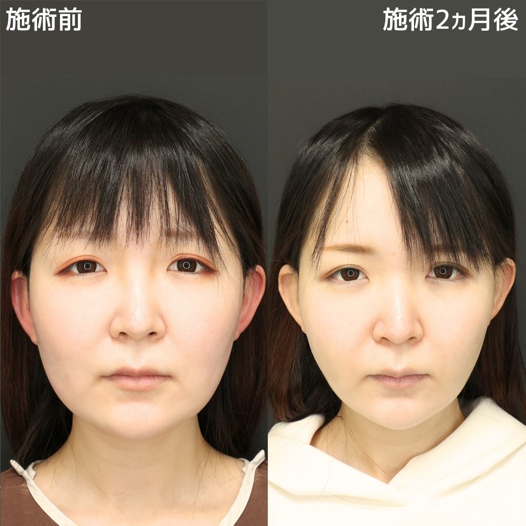 TAC式 ツヤ肌コラーゲンリフト®/Lラインファット除去(エラ下脂肪除去)/ジョールファット除去の症例写真 施術前後