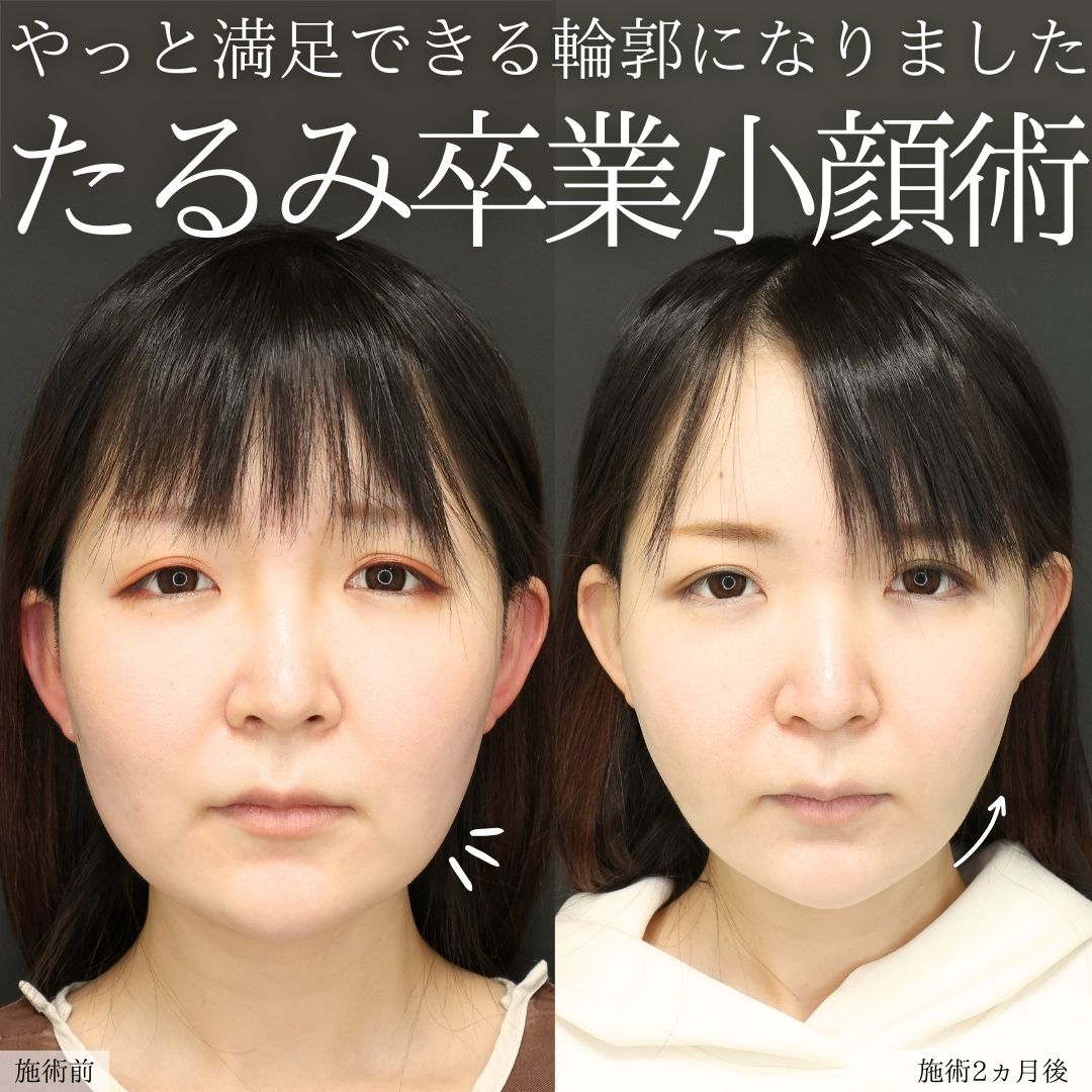 TAC式 ツヤ肌コラーゲンリフト®/Lラインファット除去(エラ下脂肪除去)/ジョールファット除去の症例写真 施術前後