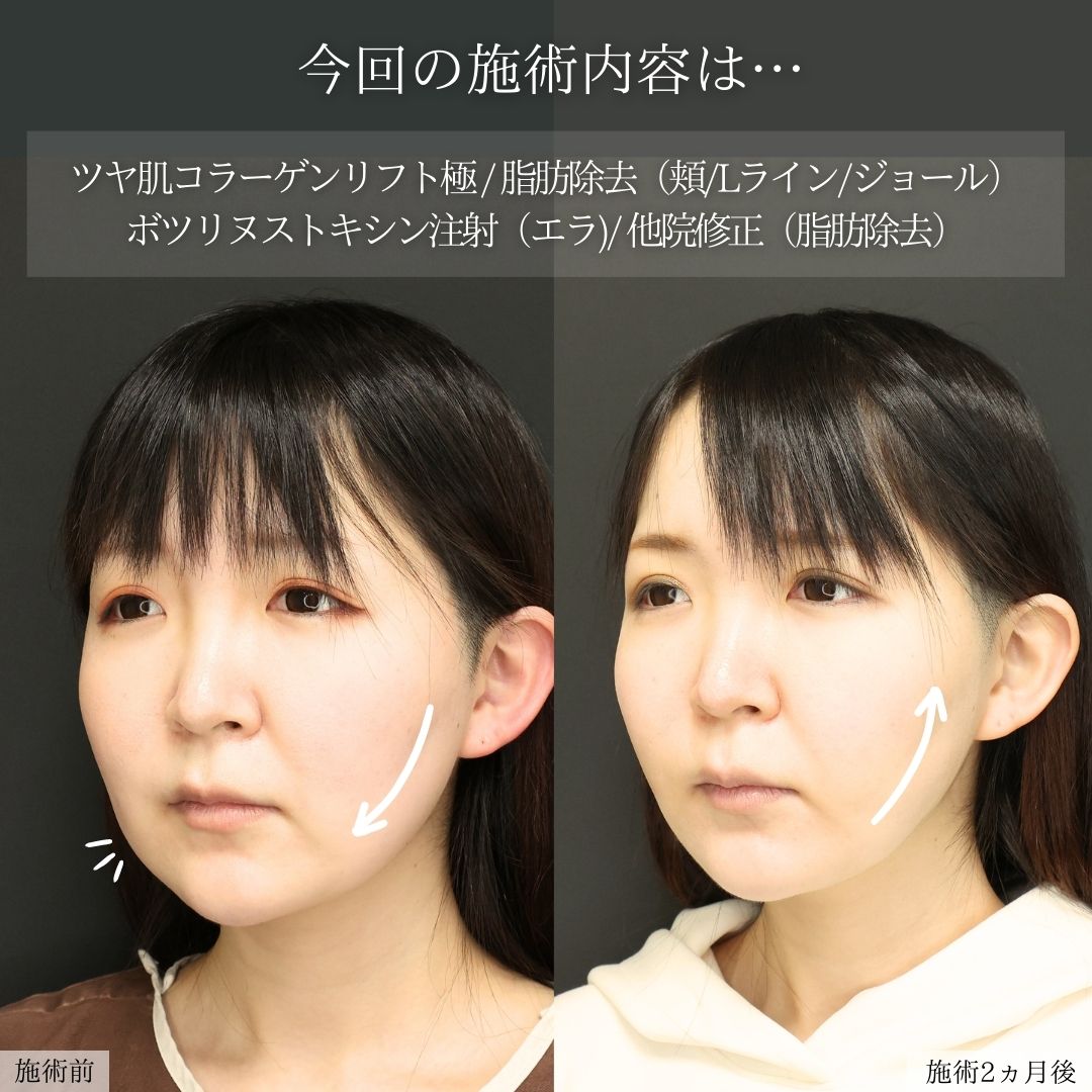 TAC式 ツヤ肌コラーゲンリフト®/Lラインファット除去(エラ下脂肪除去)/ジョールファット除去の症例写真 施術前後