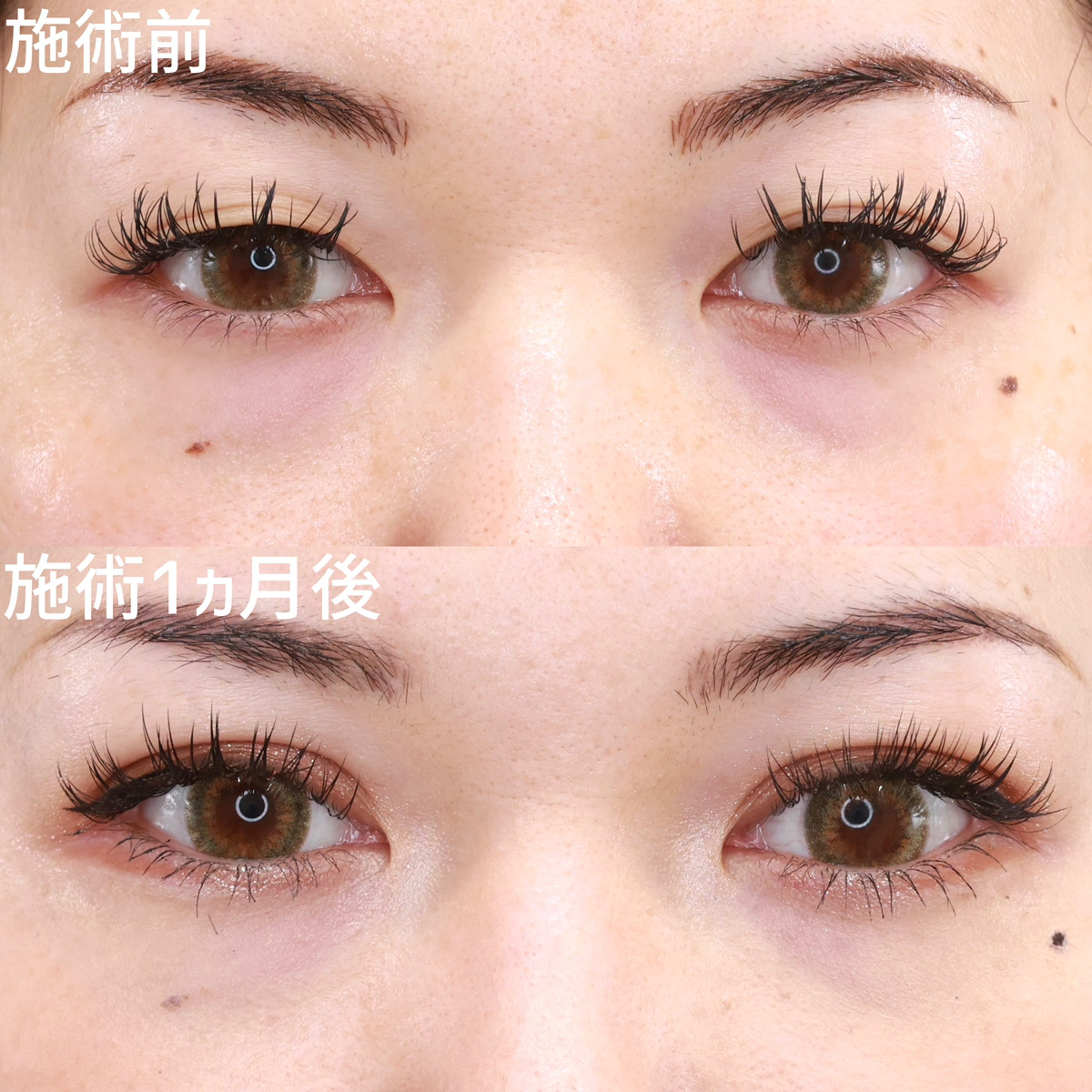 【二重埋没法】クッキリと安定した平行二重に！