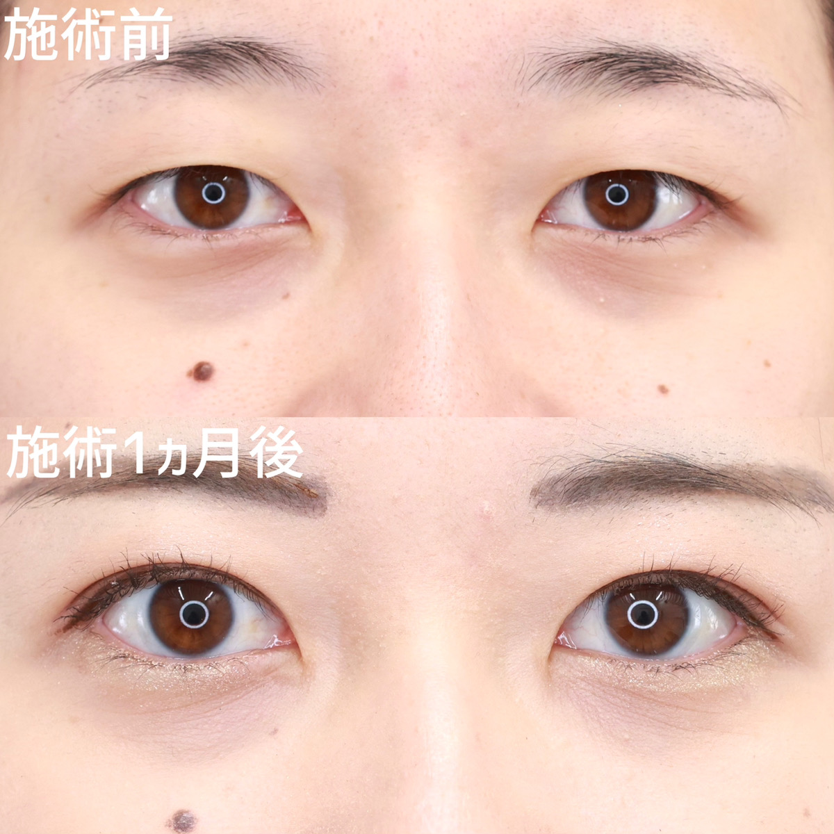 二重埋没法の症例写真 施術前後