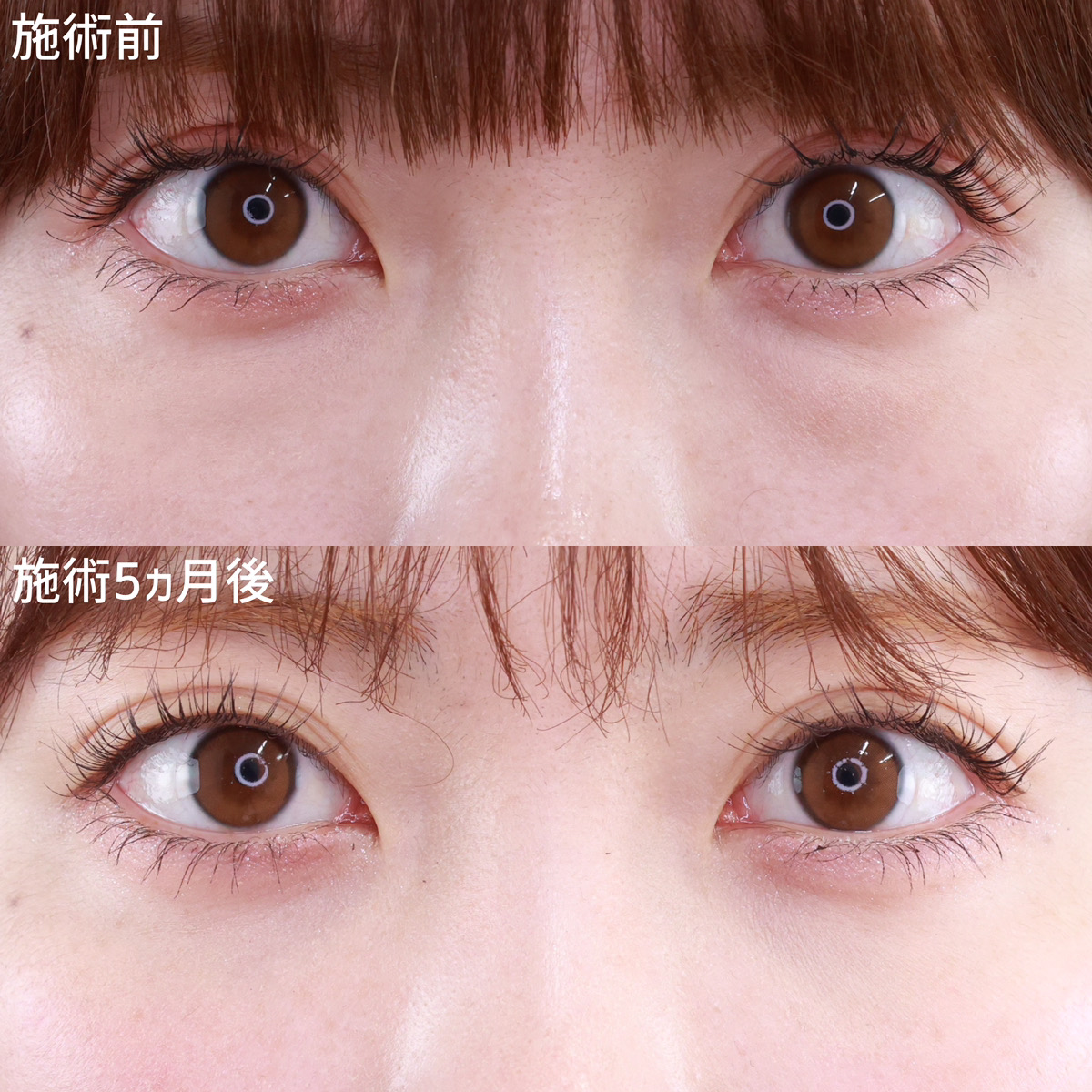 【クマ取り】目の下のふくらみを改善し、目元の可愛さUP！