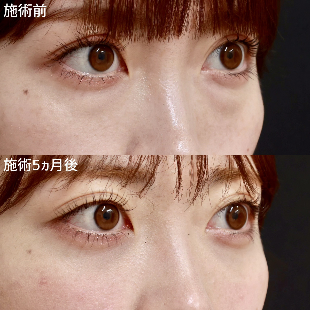 下眼瞼脱脂術（目の下のたるみ取り・目の下の脂肪ふくらみ取り）/顔の脂肪注入(コンデンスリッチフェイス)の症例写真 施術前後 
