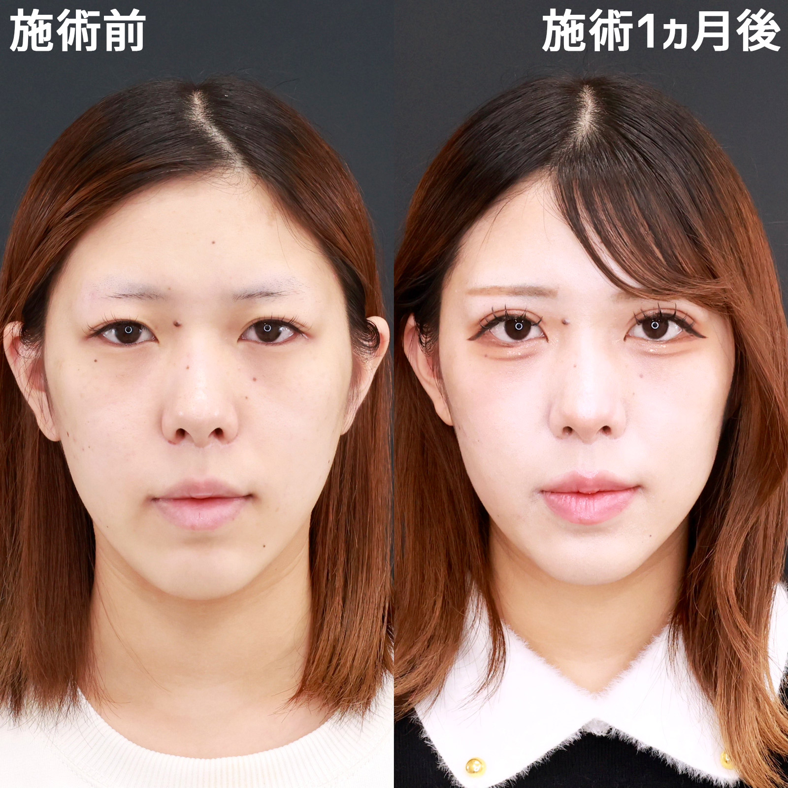 セレクト美容塾・眼瞼 セレクト美容塾・眼瞼 改訂第2版 | 克誠堂出版