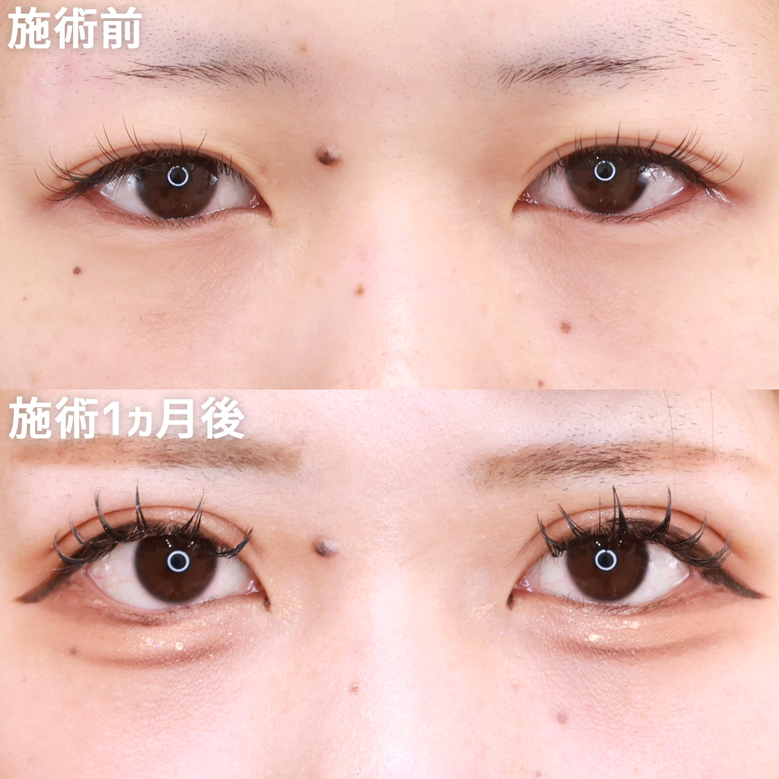 上眼瞼切開術/グラマラスライン（タレ目形成）の症例写真 施術前後 