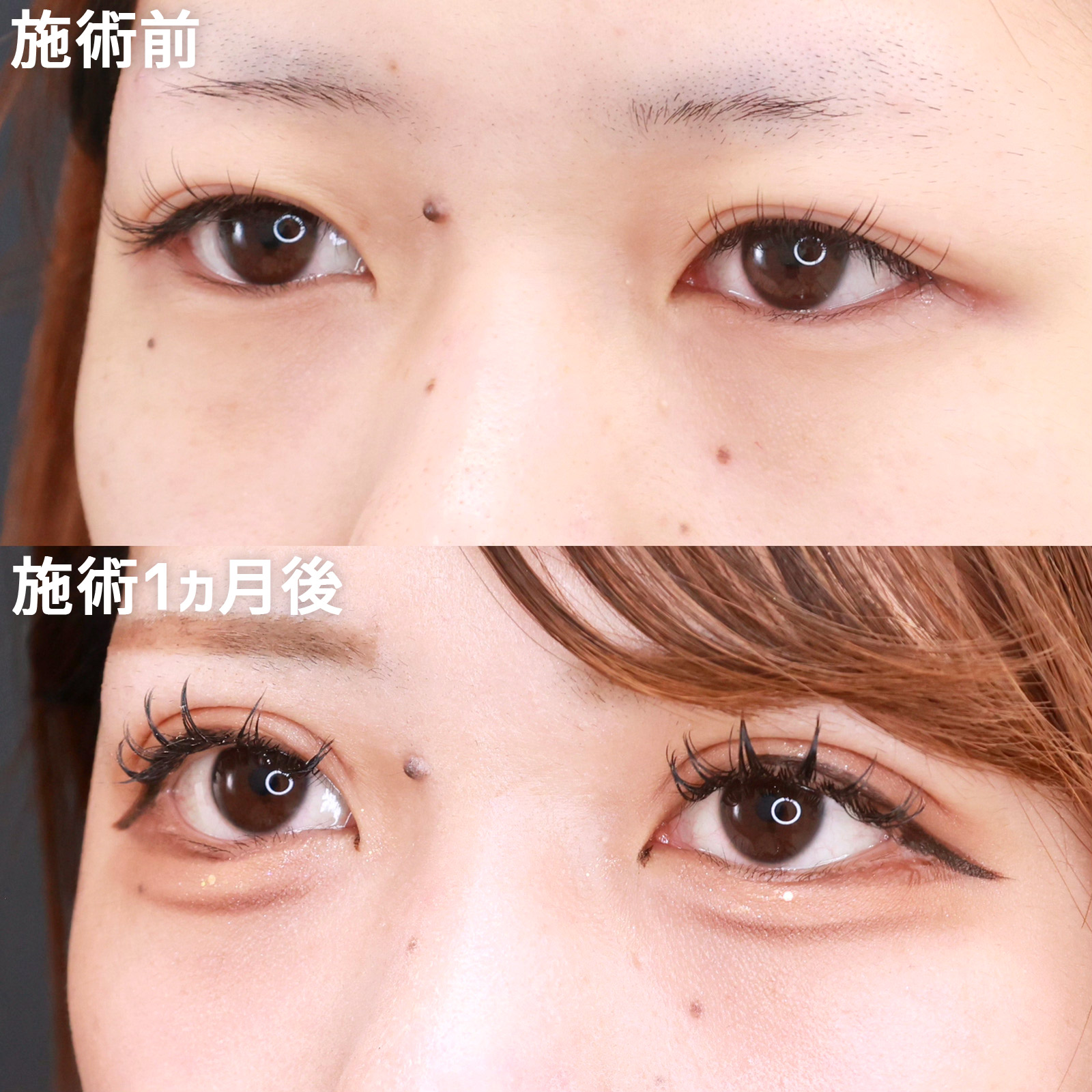 上眼瞼切開術/グラマラスライン（タレ目形成）の症例写真 施術前後 