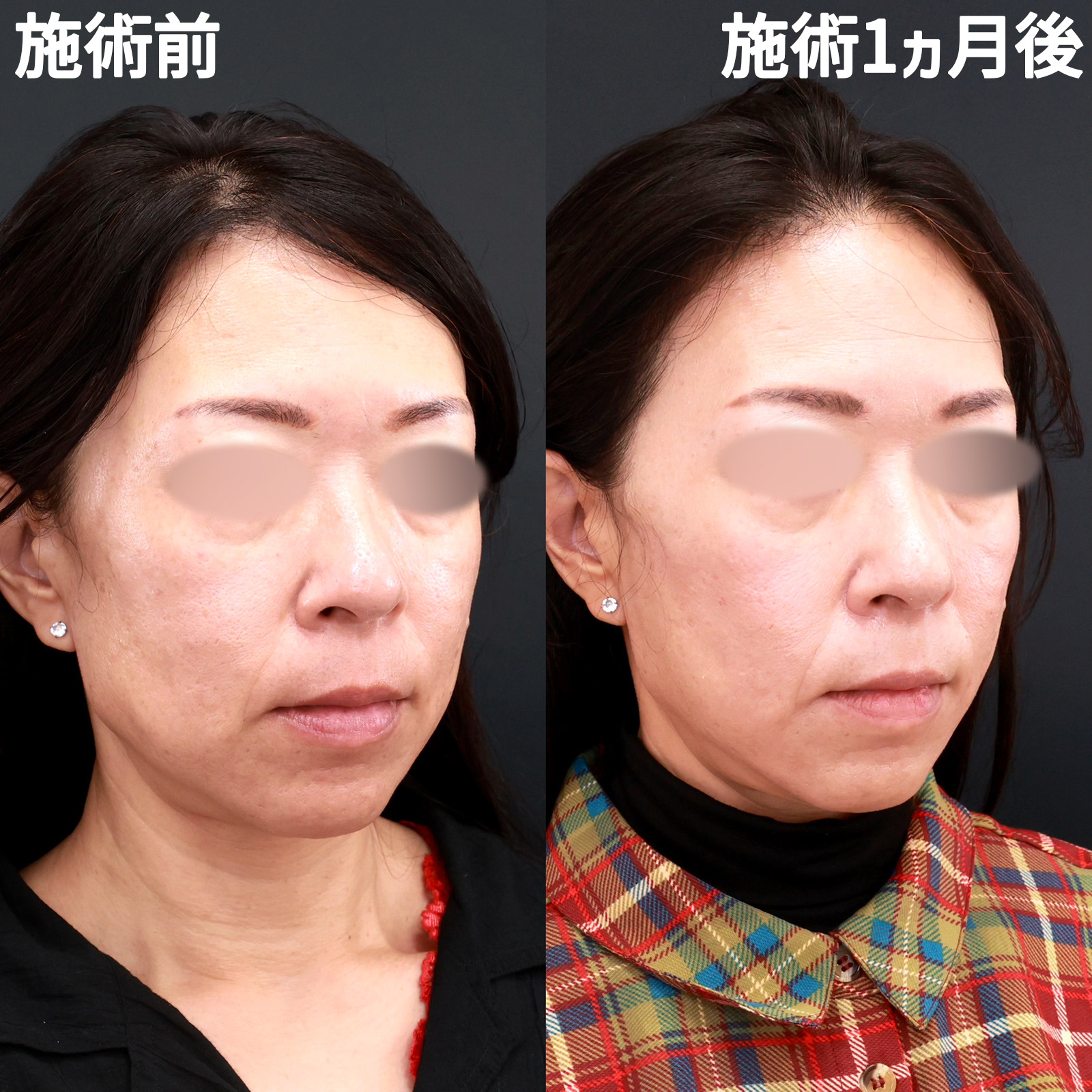 TAC式 ツヤ肌コラーゲンリフト®/エラボトックス注射の症例写真 施術前後 