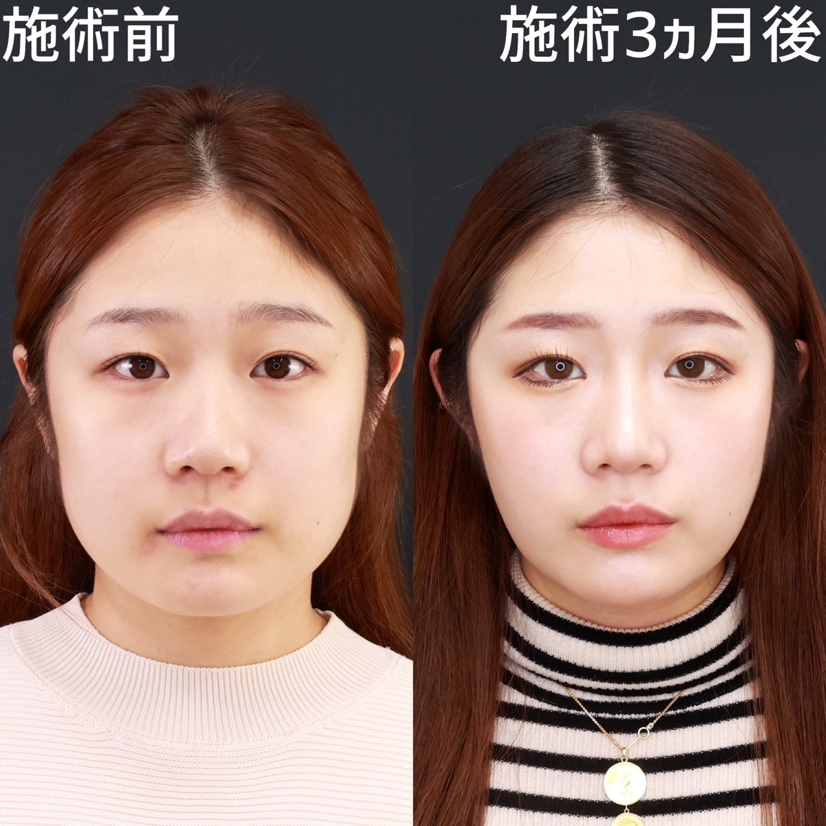 【糸リフト×脂肪吸引】お顔のボリュームダウンでスッキリと垢抜け！