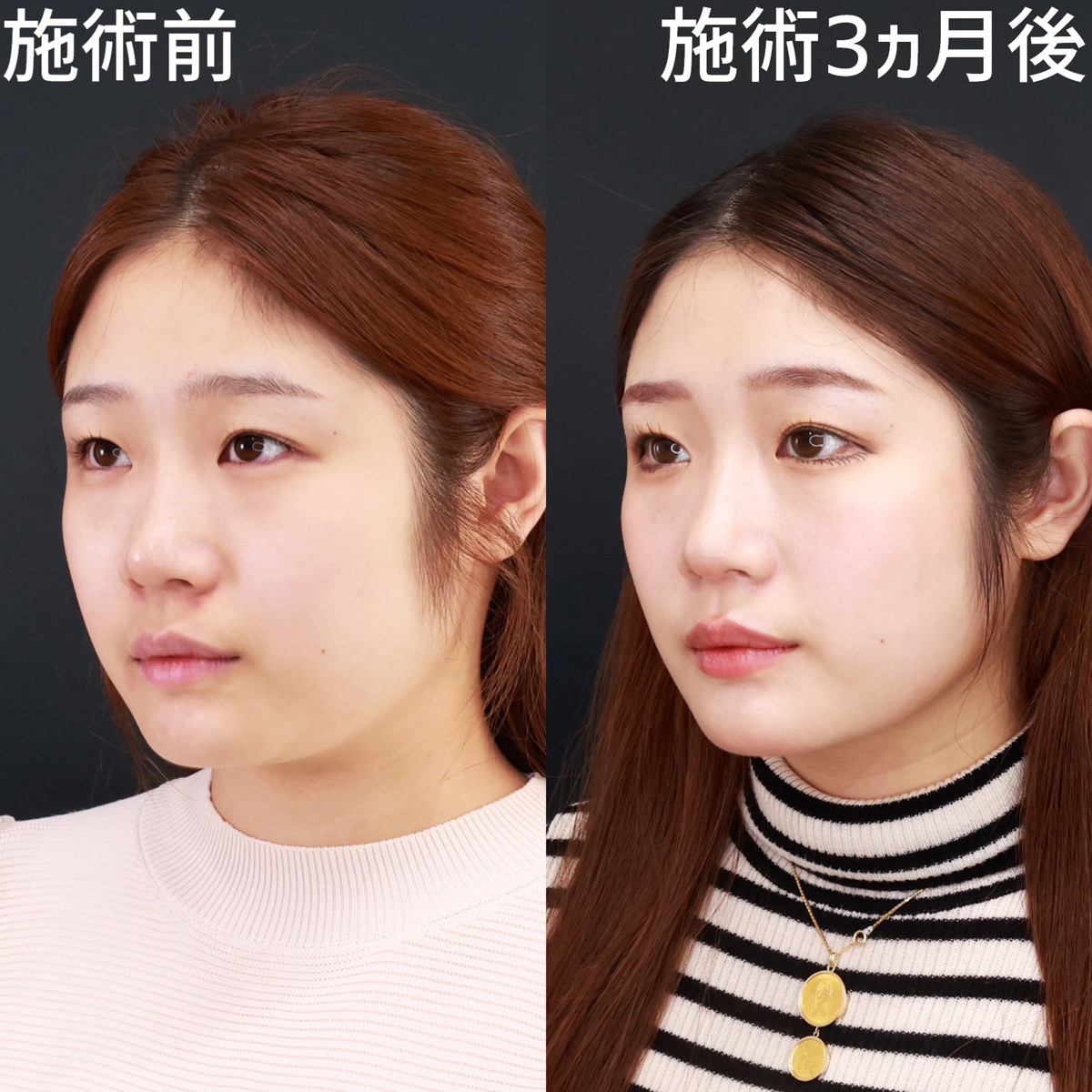 TAC式 ツヤ肌コラーゲンリフト®/バッカルファット除去/ジョールファット除去の症例写真 施術前後 