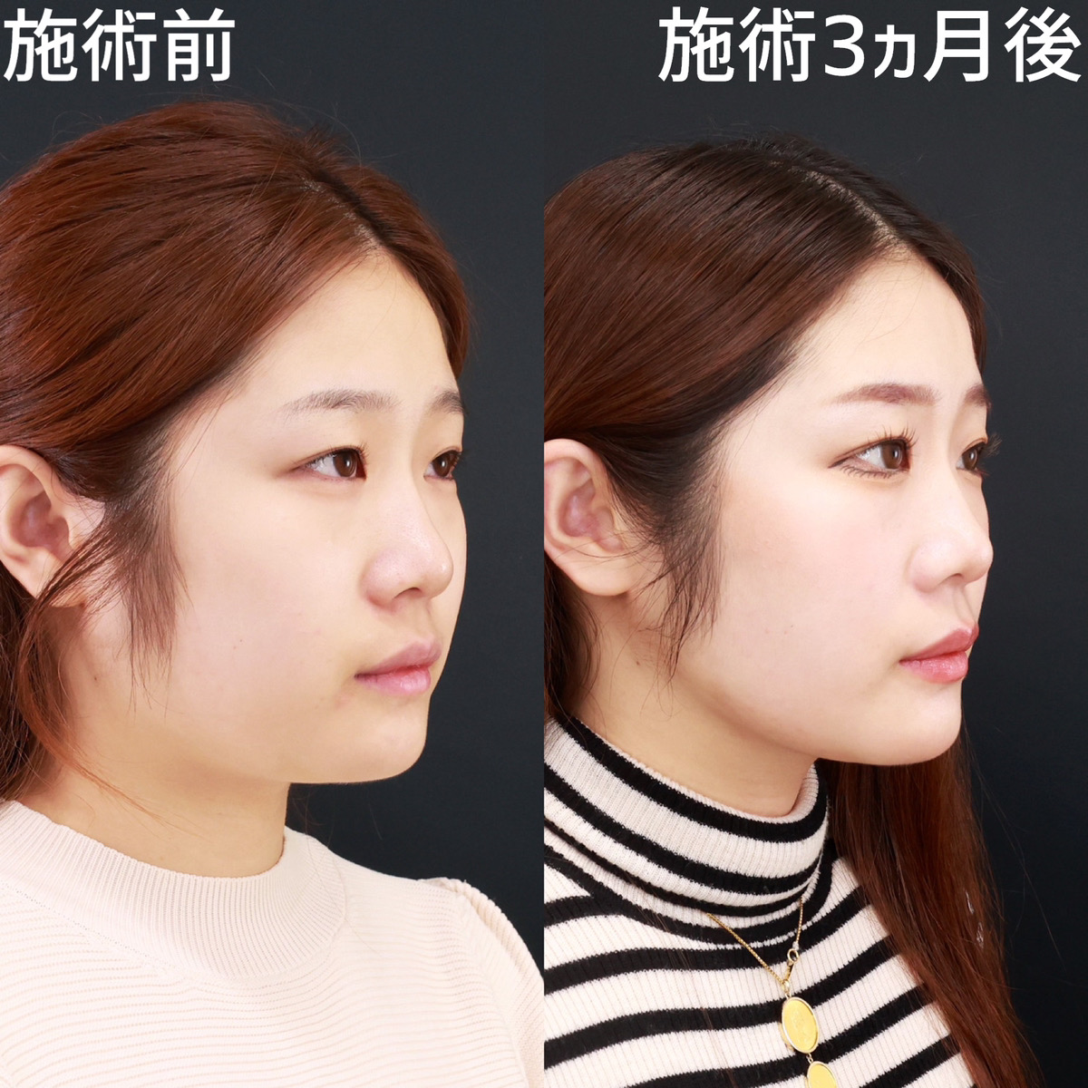 TAC式 ツヤ肌コラーゲンリフト®/バッカルファット除去/ジョールファット除去の症例写真 施術前後 