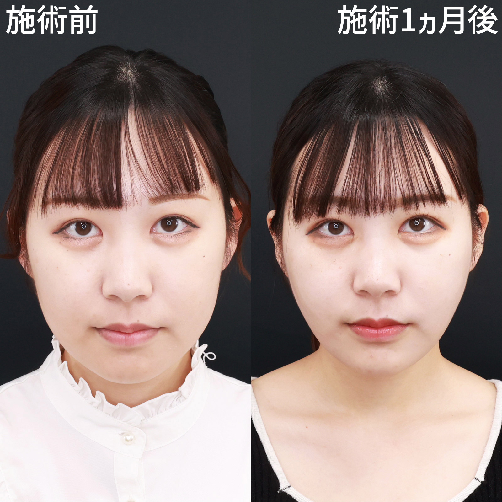 小顔整形｜パーフェクトフェイスライン/バッカルファット除去/ジョールファット除去の症例写真 施術前後 