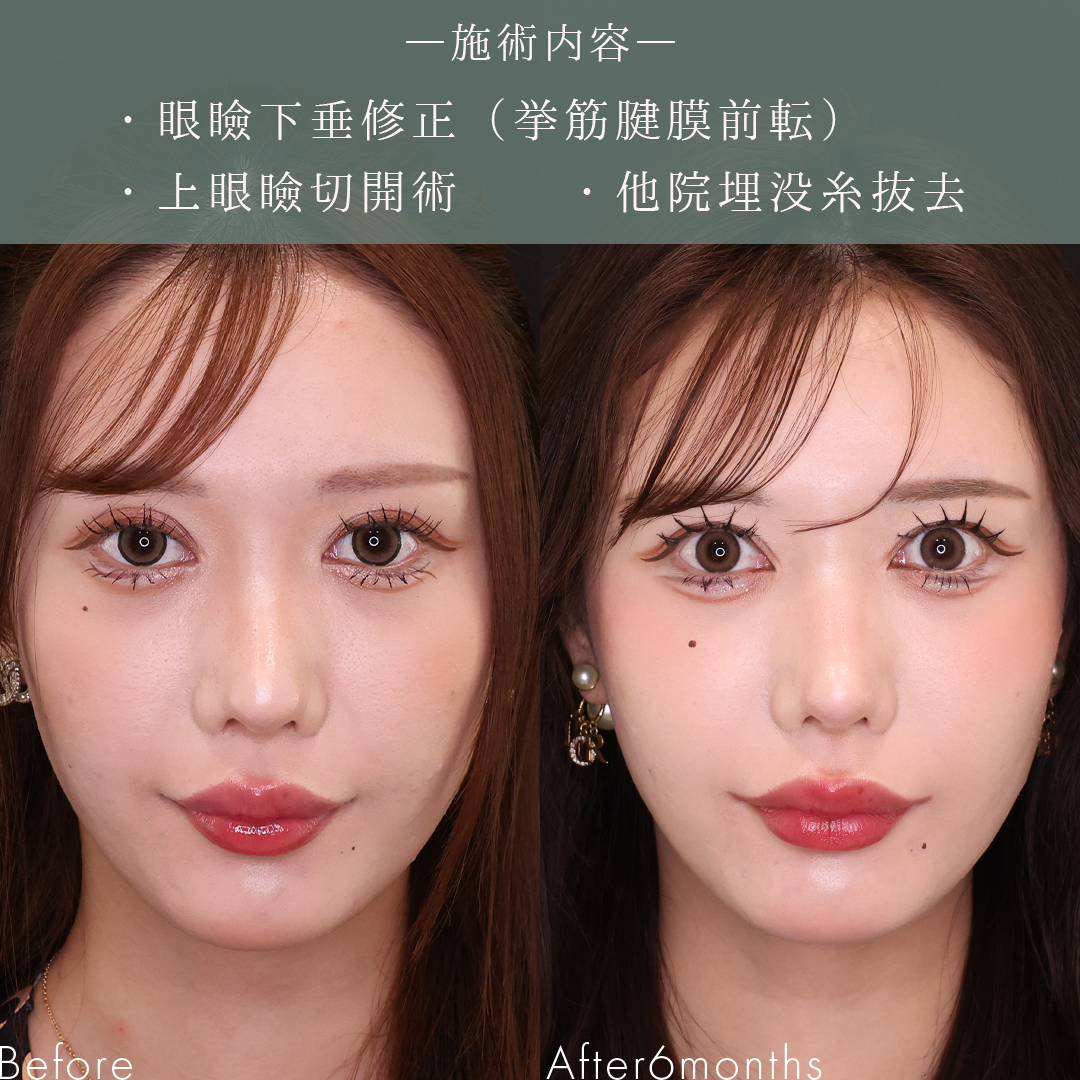 眼瞼下垂（目つき矯正）/上眼瞼切開術の症例写真 施術前後 