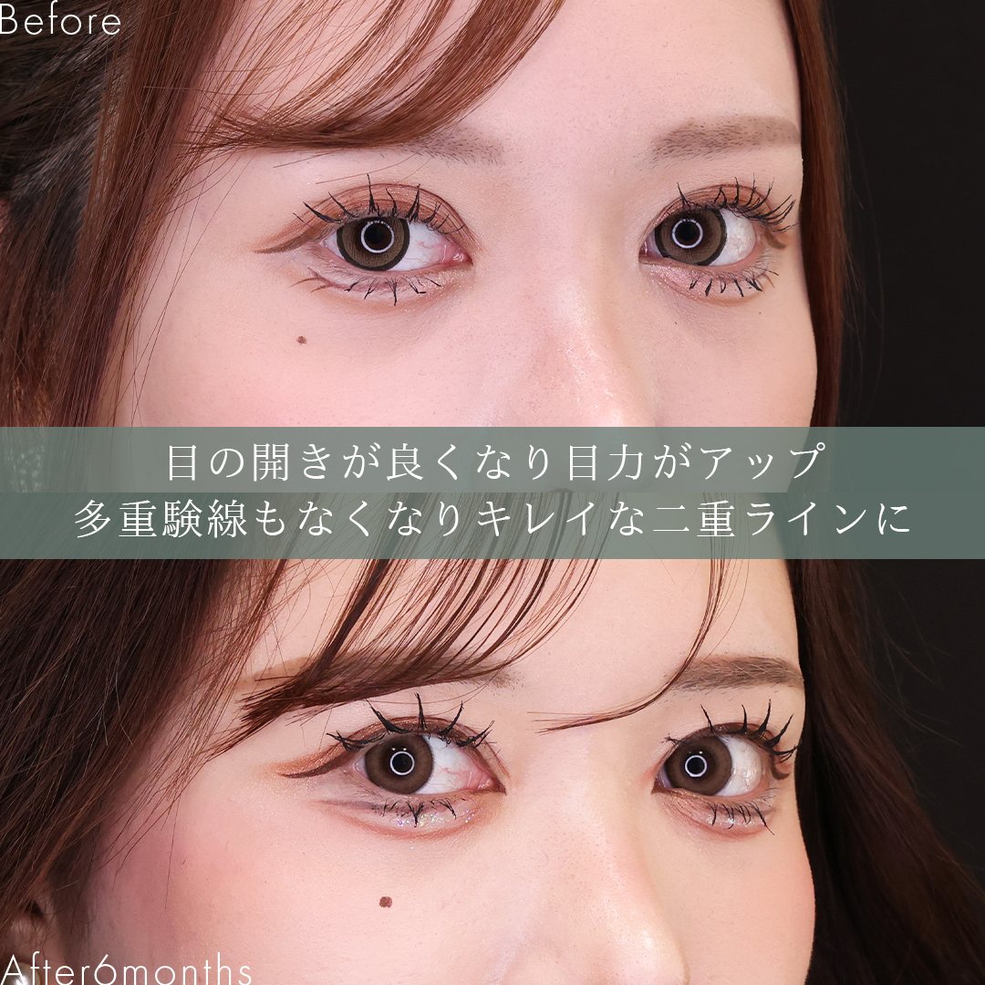 眼瞼下垂（目つき矯正）/上眼瞼切開術の症例写真 施術前後 