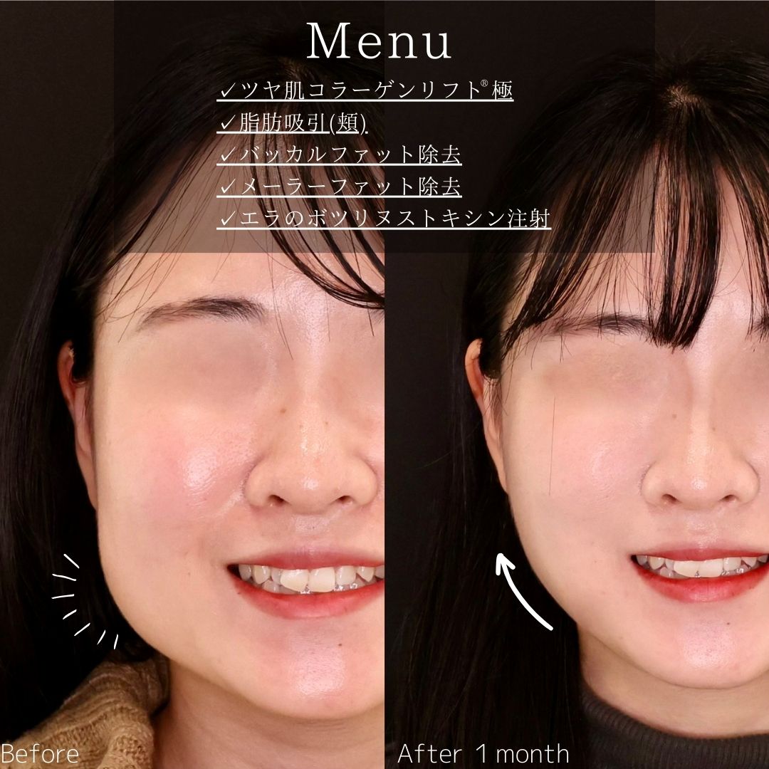 TAC式 ツヤ肌コラーゲンリフト®/顎下の脂肪吸引/バッカルファット除去の症例写真 施術前後 