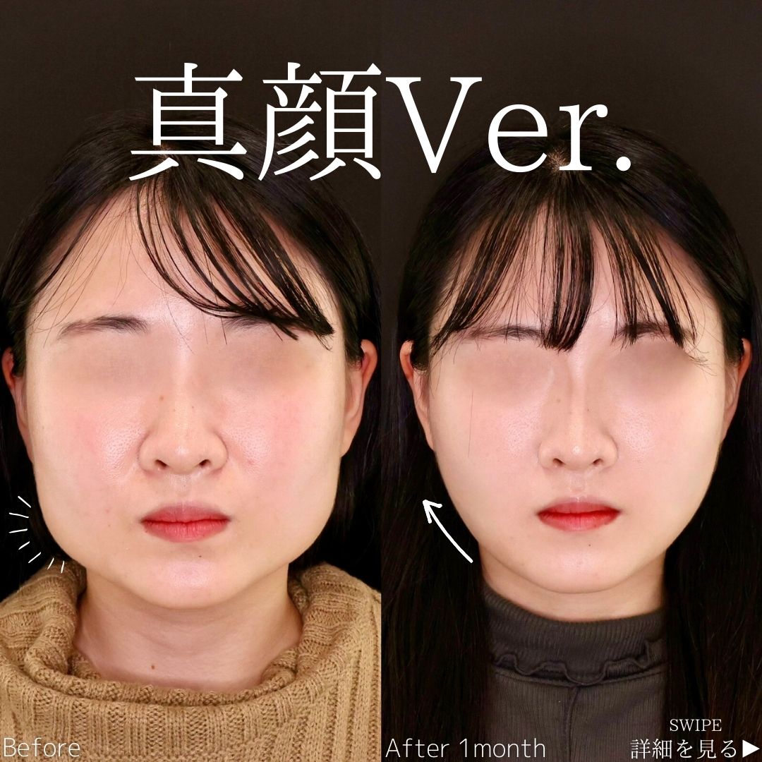 TAC式 ツヤ肌コラーゲンリフト®/顎下の脂肪吸引/バッカルファット除去の症例写真 施術前後 