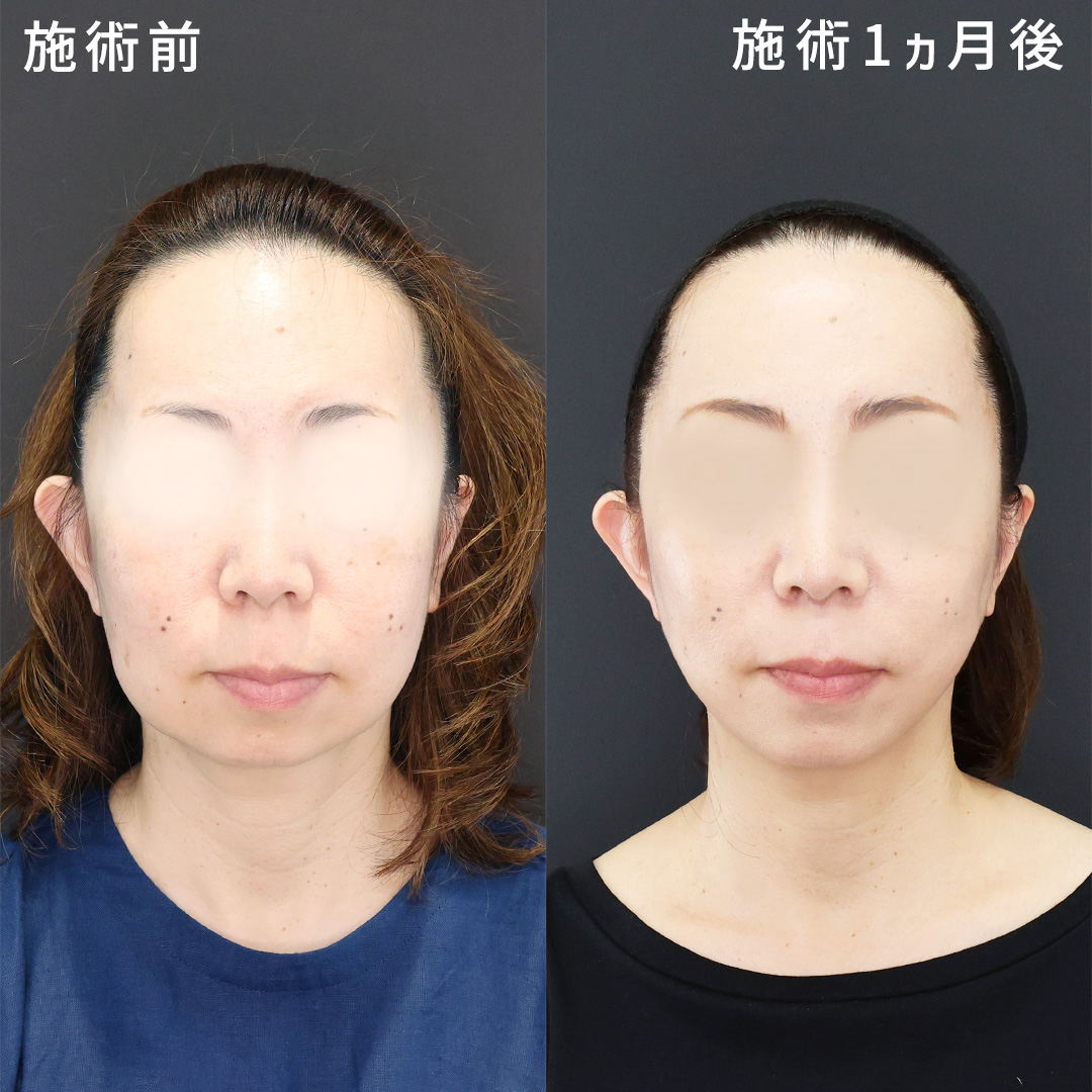 40・50代｜ミドル世代の輪郭ケア