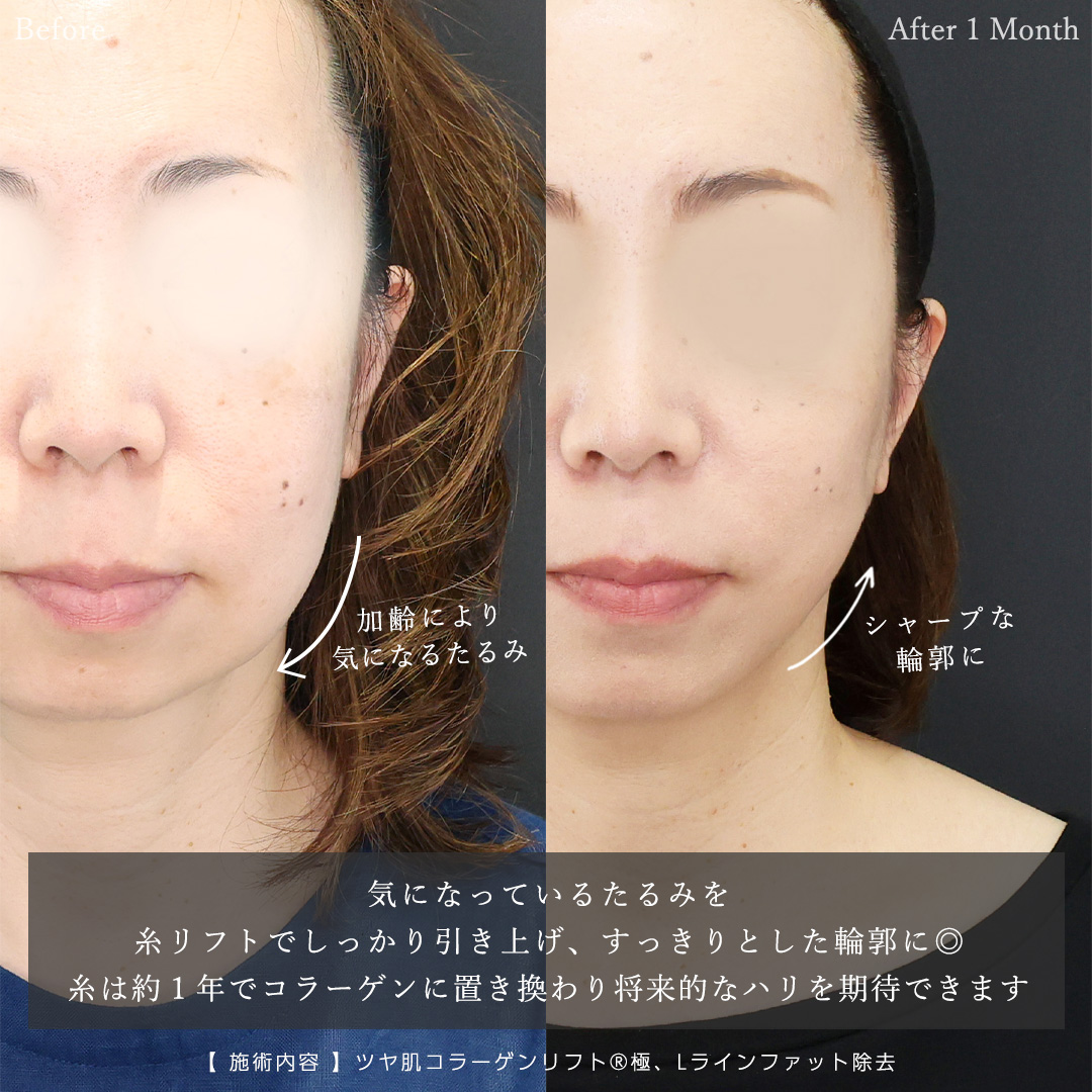TAC式 ツヤ肌コラーゲンリフト®/Lラインファット除去（エラ下脂肪除去）の症例写真 施術前後 
