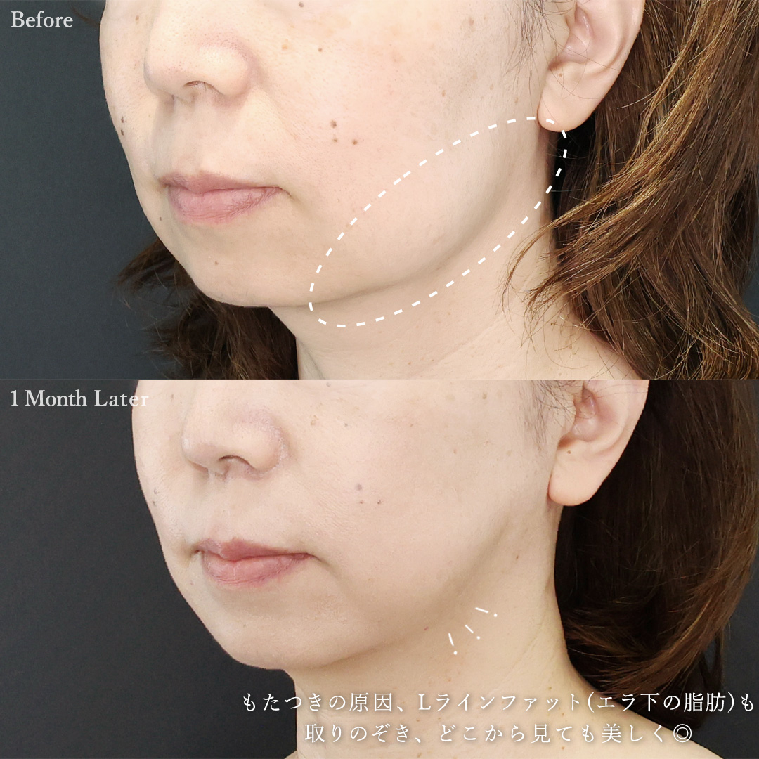 TAC式 ツヤ肌コラーゲンリフト®/Lラインファット除去（エラ下脂肪除去）の症例写真 施術前後 