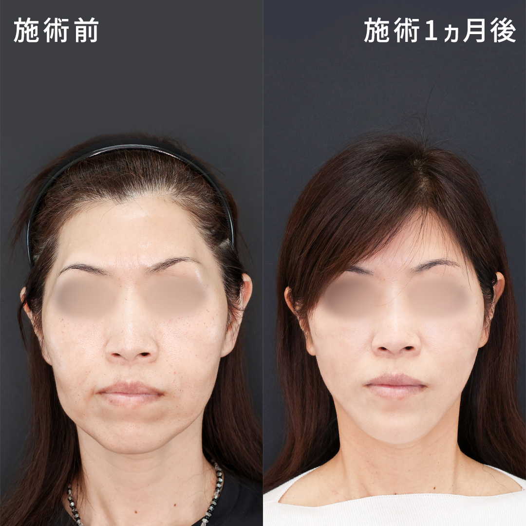 《-10才若返り？！》たるみ・もたつき改善