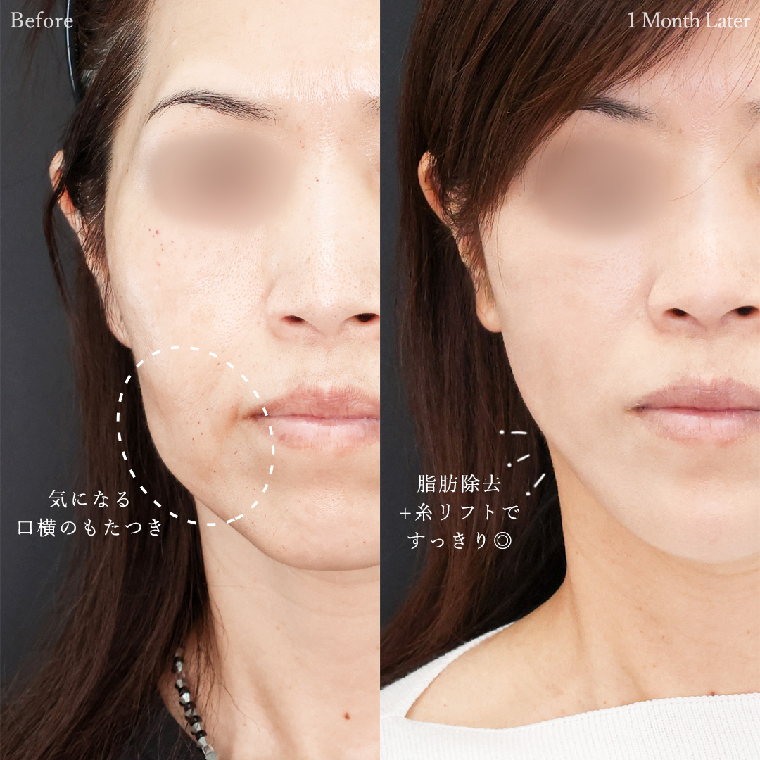 TAC式 ツヤ肌コラーゲンリフト®/ジョールファット除去/Lラインファット除去(エラ下脂肪除去)の症例写真 施術前後