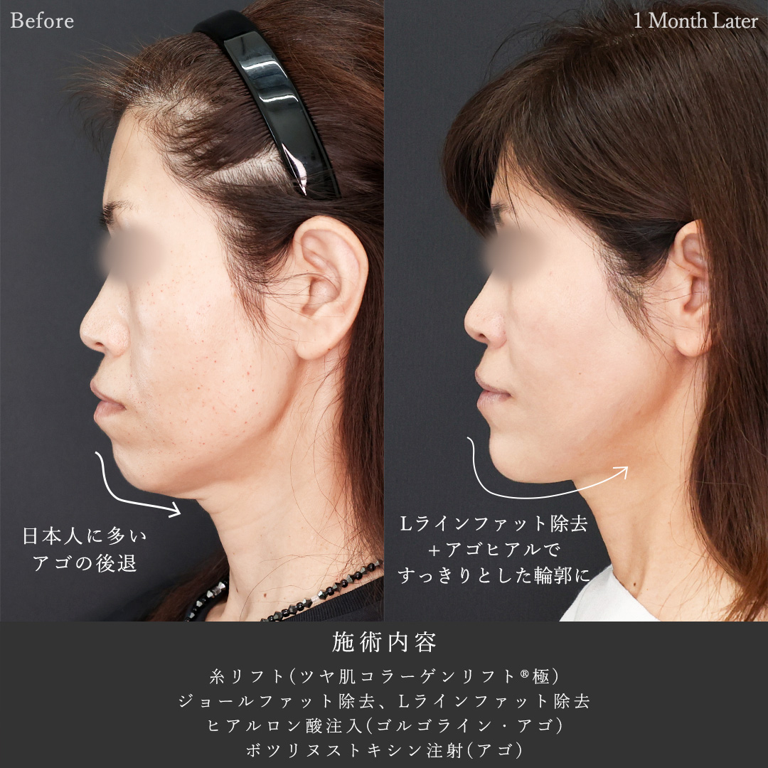 TAC式 ツヤ肌コラーゲンリフト®/ジョールファット除去/Lラインファット除去(エラ下脂肪除去)の症例写真 施術前後