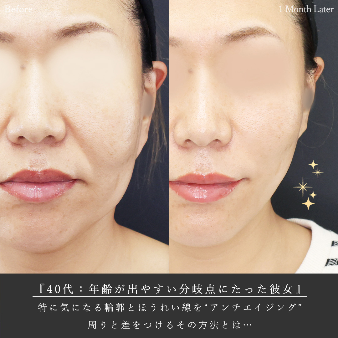 TAC式 ツヤ肌コラーゲンリフト®/Lラインファット除去（エラ下脂肪除去）/顔の脂肪吸引の症例写真 施術前後 