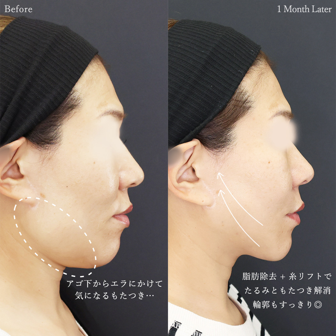 TAC式 ツヤ肌コラーゲンリフト®/Lラインファット除去（エラ下脂肪除去）/顔の脂肪吸引の症例写真 施術前後 