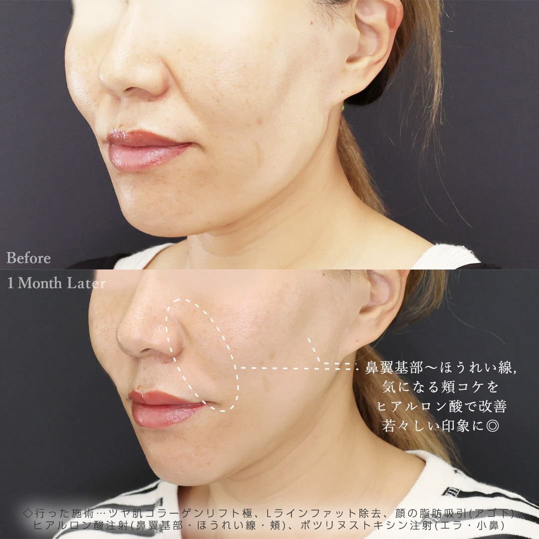 TAC式 ツヤ肌コラーゲンリフト®/Lラインファット除去（エラ下脂肪除去）/顔の脂肪吸引の症例写真 施術前後 