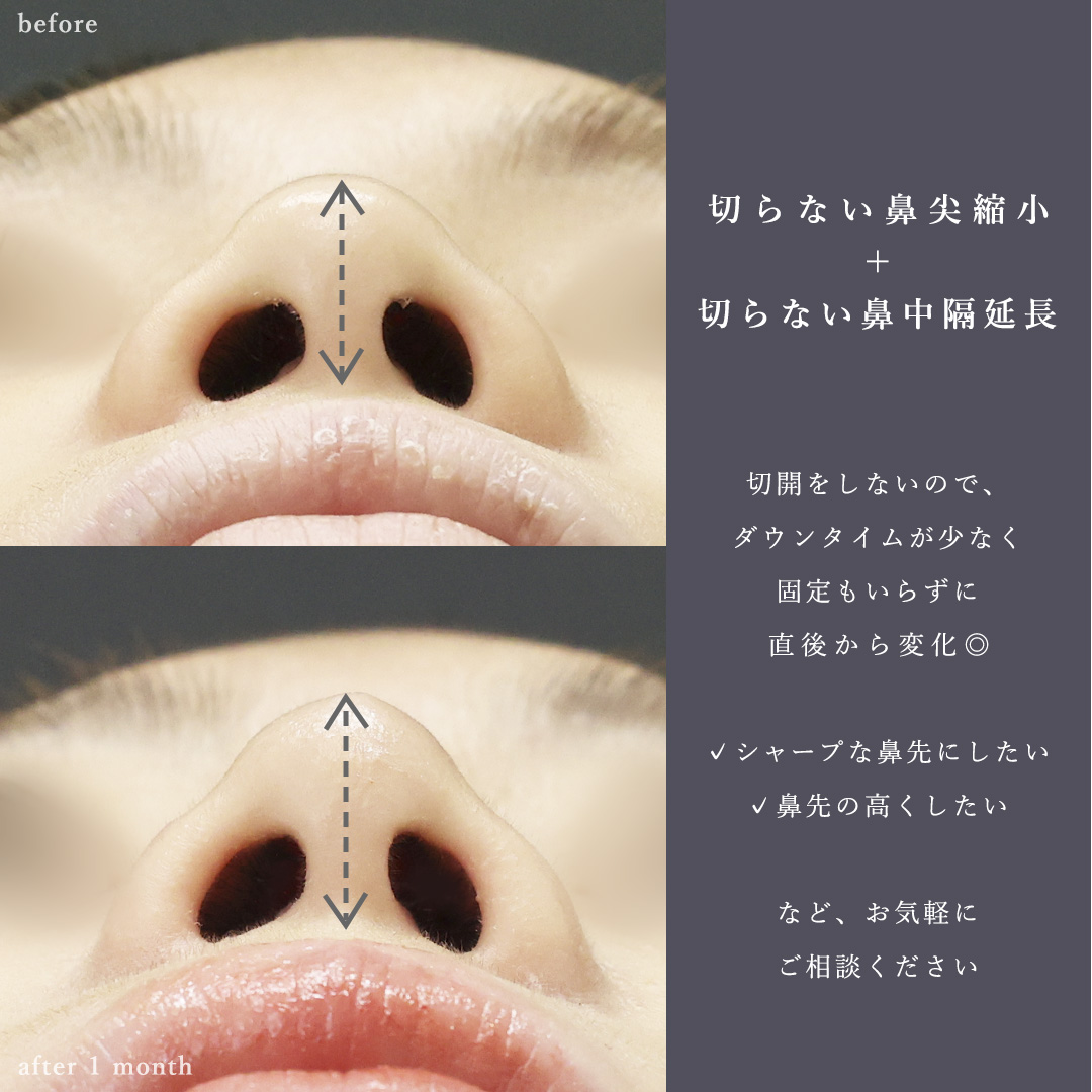 鼻尖形成・鼻尖縮小/ヴィーナスノーズ（切らない鼻中隔延長術）の症例写真 施術前後 