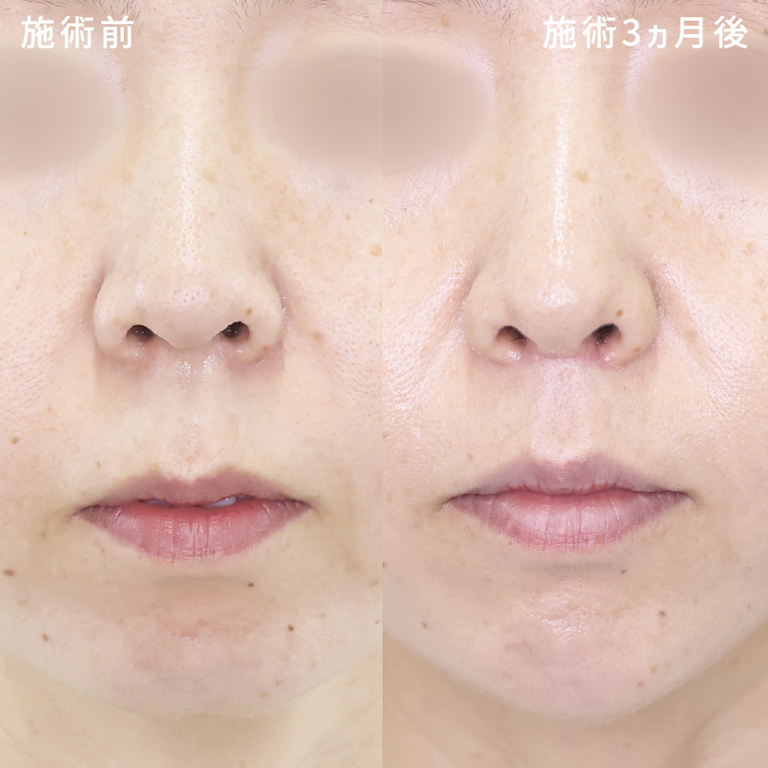 人中短縮術(リップリフト)・外側人中短縮術/顎のヒアルロン酸注射の症例写真 施術前後 