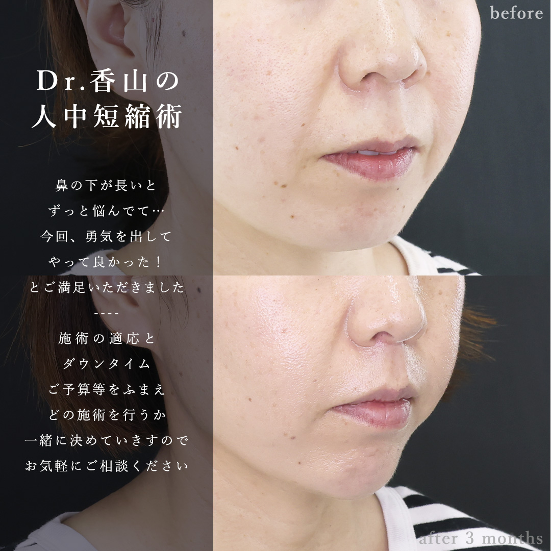 人中短縮術(リップリフト)・外側人中短縮術/顎のヒアルロン酸注射の症例写真 施術前後 