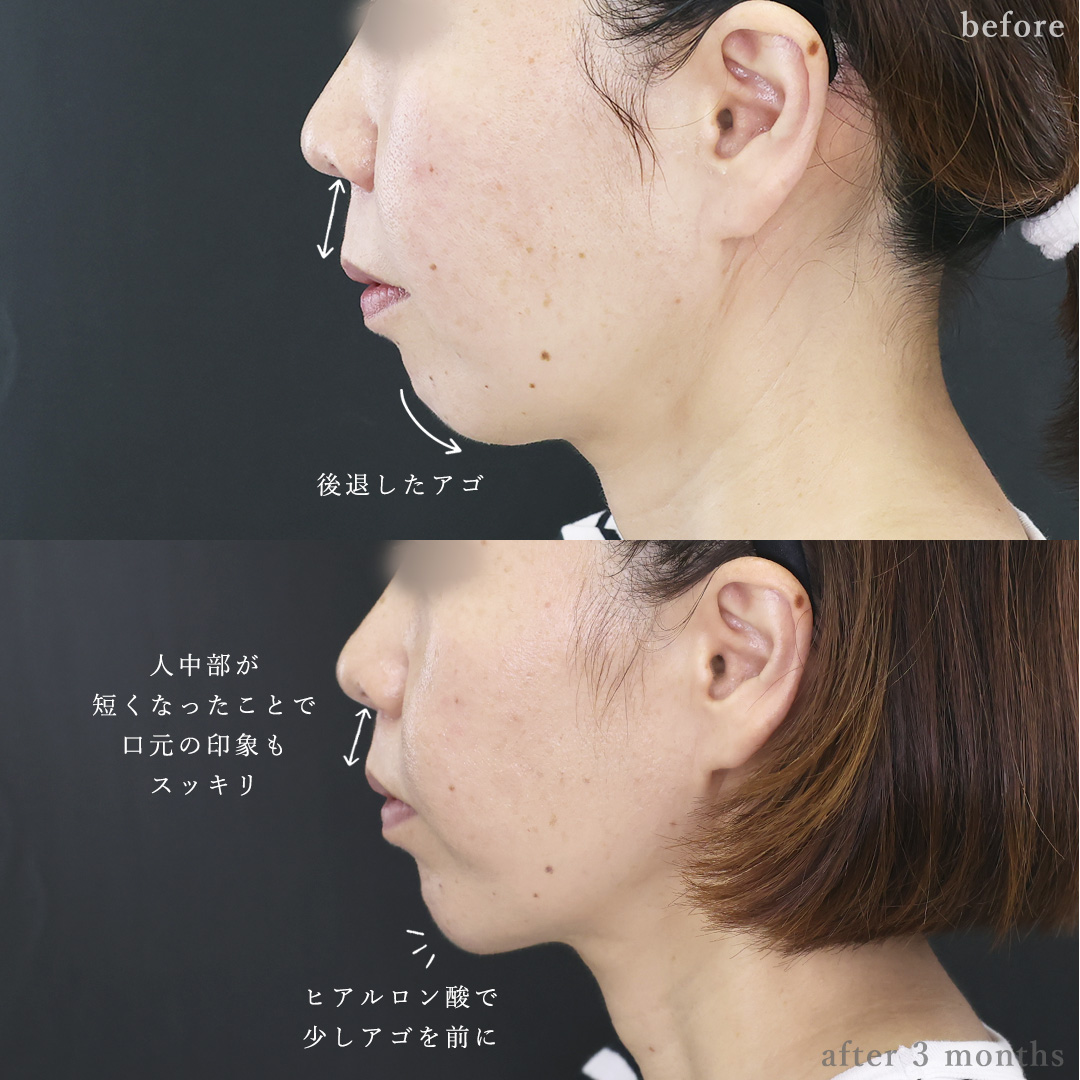 人中短縮術(リップリフト)・外側人中短縮術/顎のヒアルロン酸注射の症例写真 施術前後 