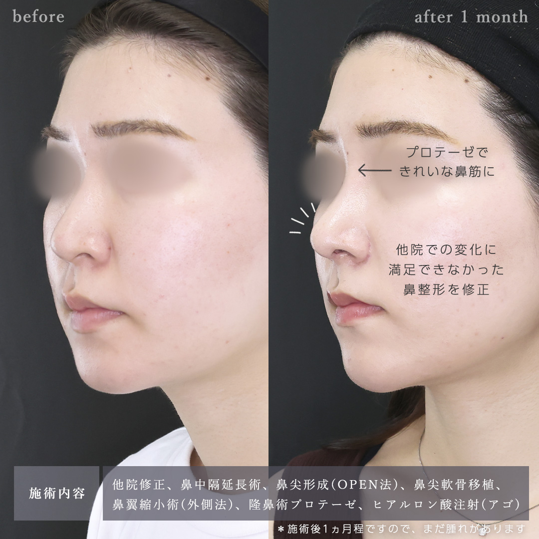 鼻中隔延長術/鼻尖形成・鼻尖縮小/鼻先軟骨移植の症例写真 施術前後 