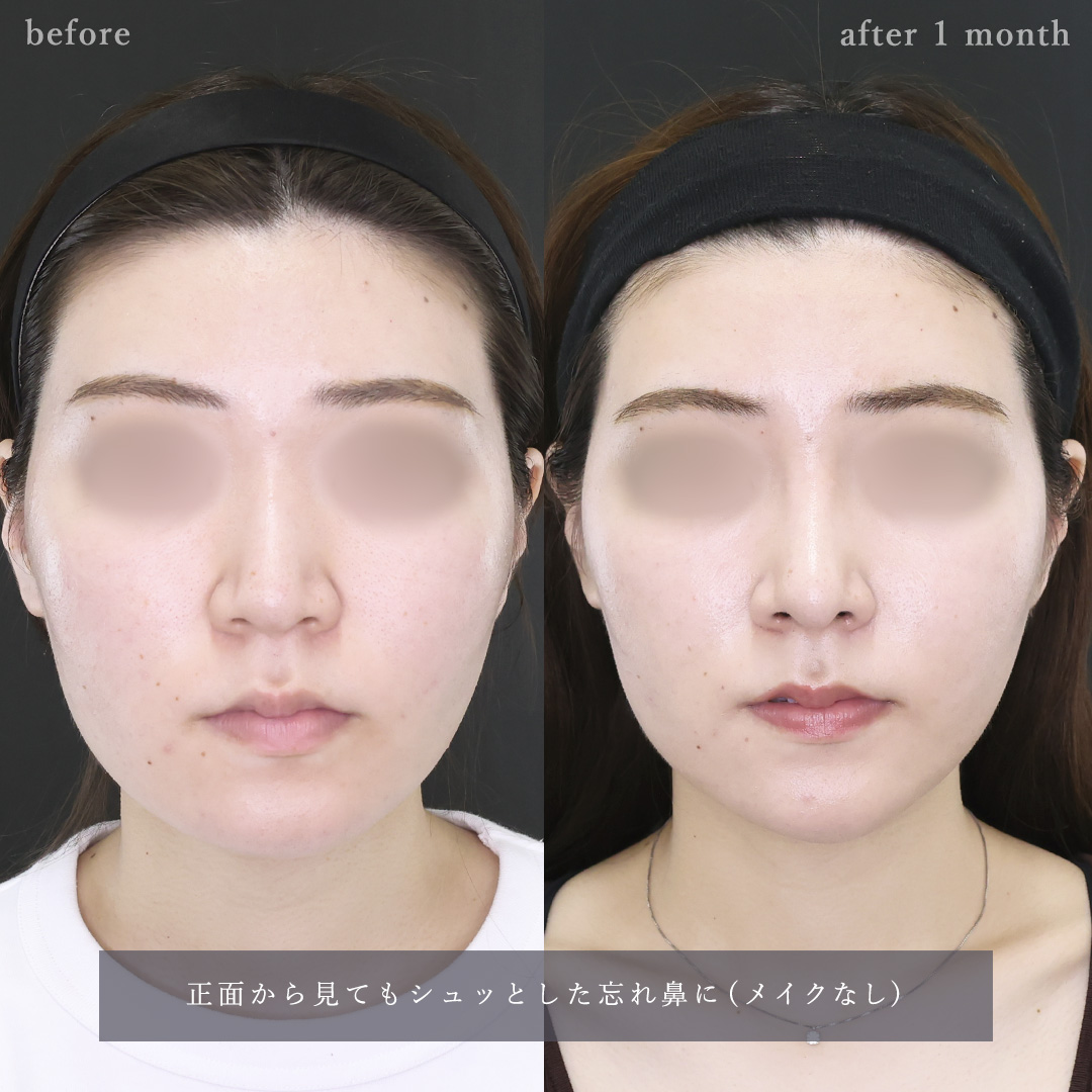 鼻中隔延長術/鼻尖形成・鼻尖縮小/鼻先軟骨移植の症例写真 施術前後 