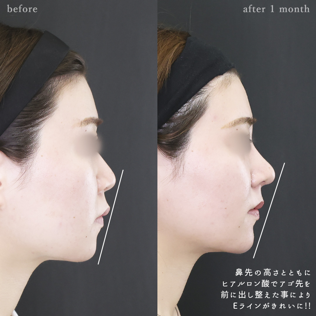 鼻中隔延長術/鼻尖形成・鼻尖縮小/鼻先軟骨移植の症例写真 施術前後 