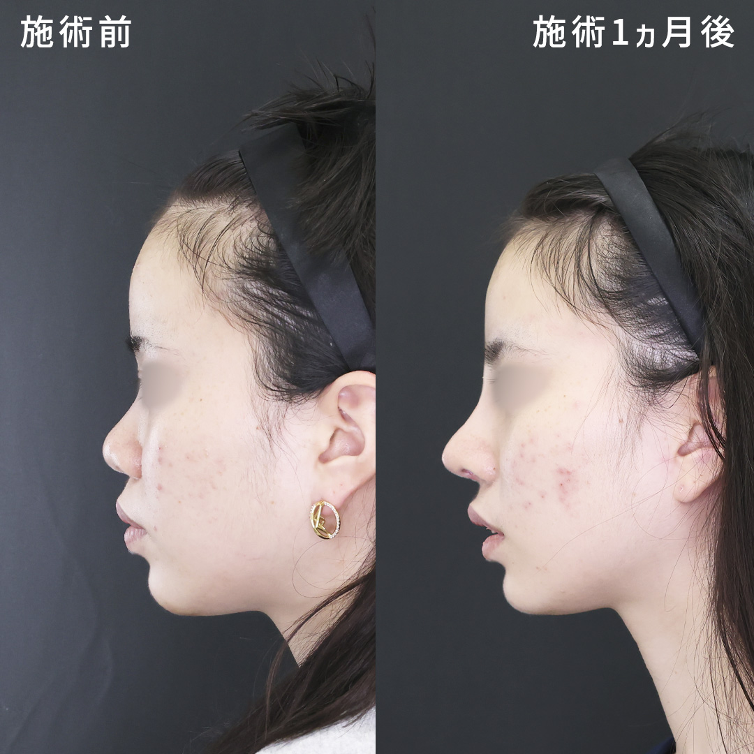 【他院修正】鼻中隔延長術で叶える鼻フル整形