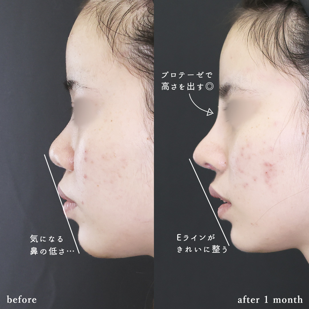 鼻中隔延長術/鼻尖形成・鼻尖縮小/鼻先軟骨移植の症例写真 施術前後 