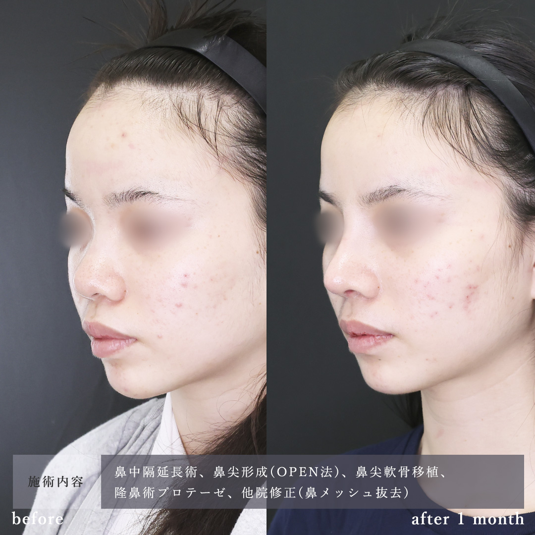 鼻中隔延長術/鼻尖形成・鼻尖縮小/鼻先軟骨移植の症例写真 施術前後 