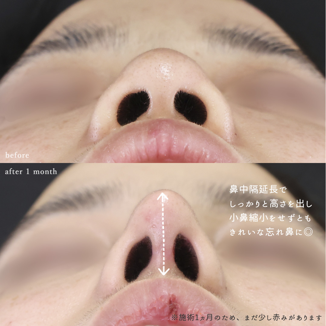 鼻中隔延長術/鼻尖形成・鼻尖縮小/鼻先軟骨移植の症例写真 施術前後 