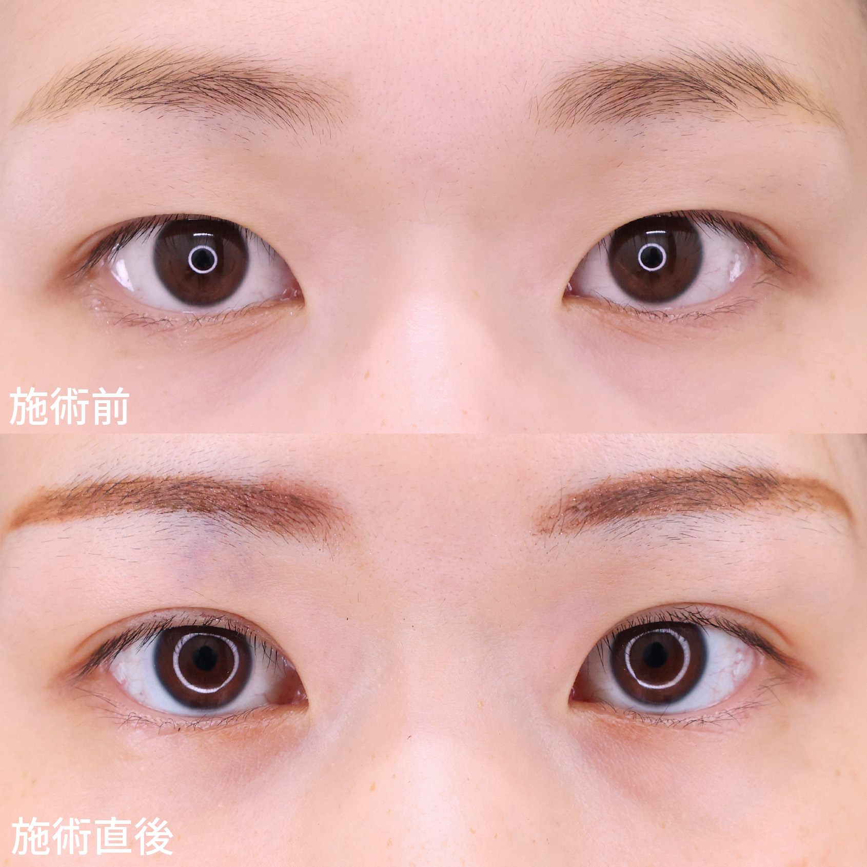 【埋没法】二重幅を広げて美人度アップ！