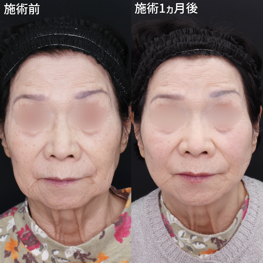 【糸リフト】で別人級変化！80代の若返り術