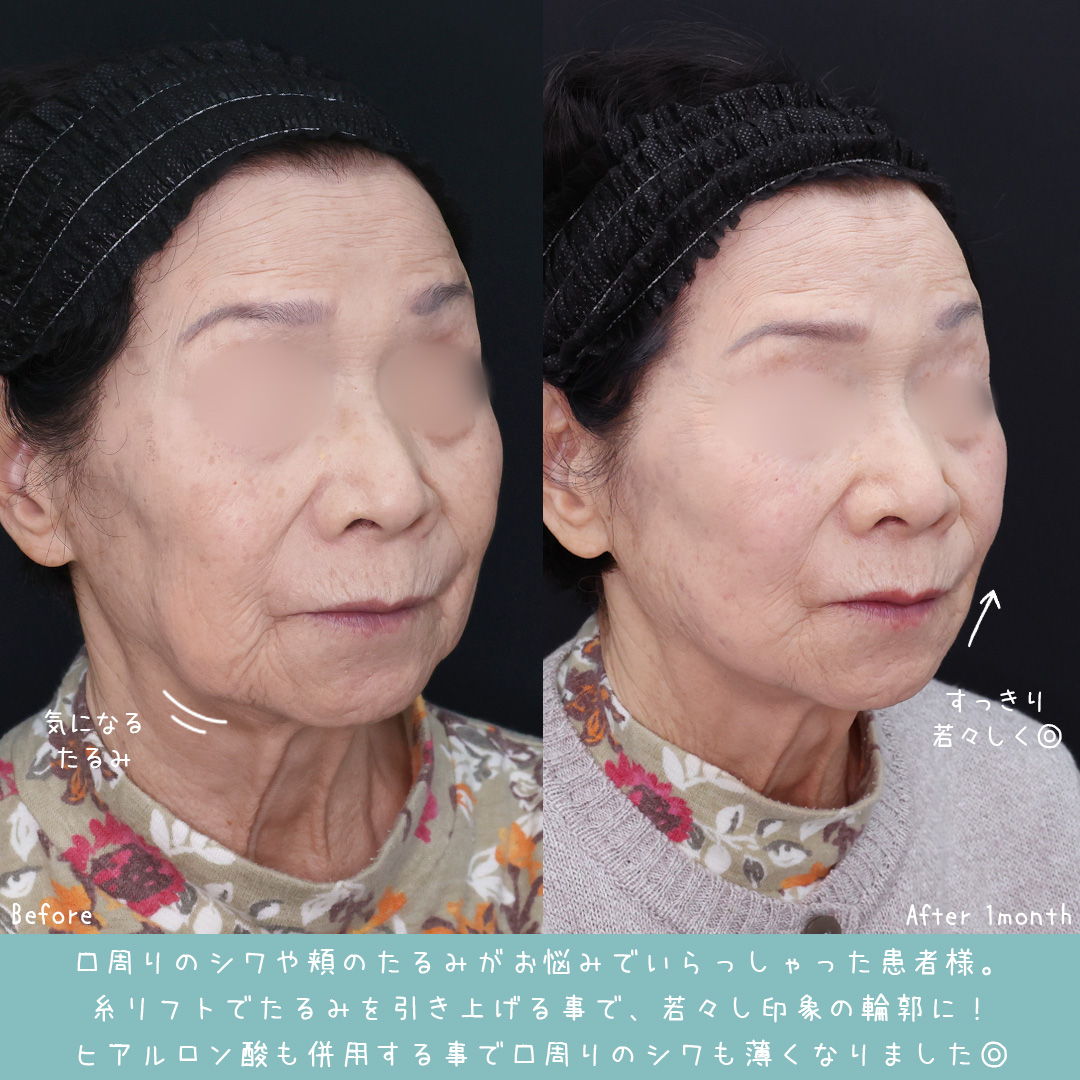 TAC式 ツヤ肌コラーゲンリフト®/マリオネットラインのヒアルロン酸注射の症例写真 施術前後