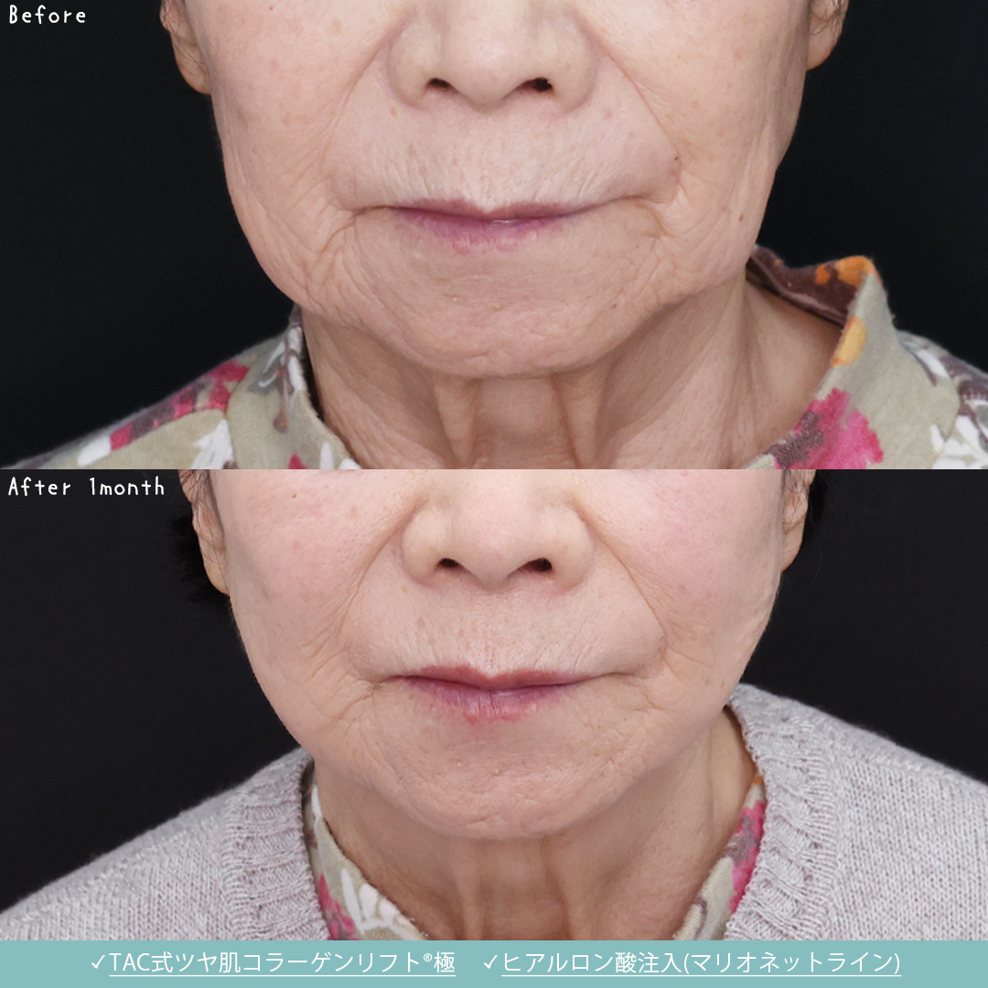 TAC式 ツヤ肌コラーゲンリフト®/マリオネットラインのヒアルロン酸注射の症例写真 施術前後