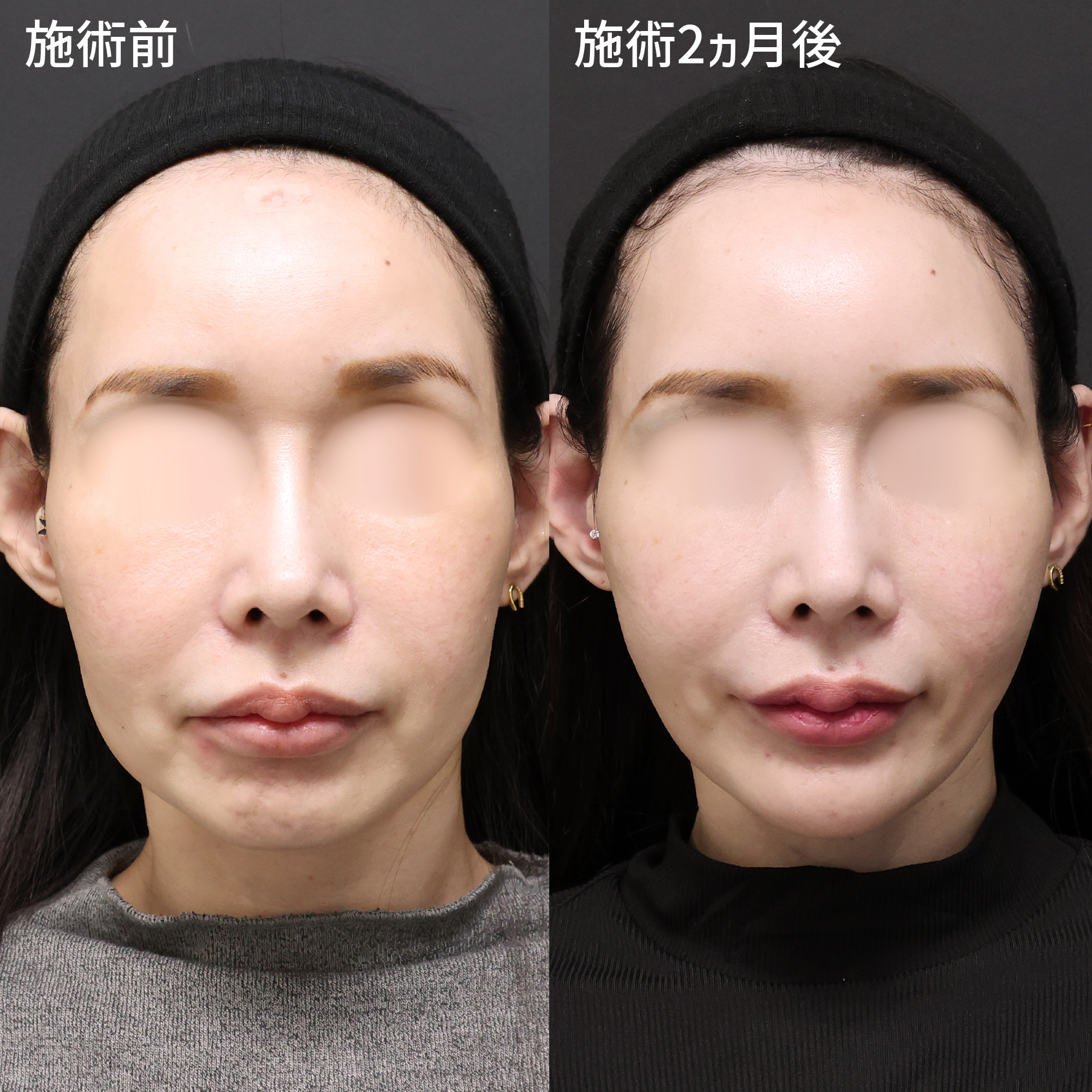 加齢によるたるみ…【糸リフト】でお悩み解消！