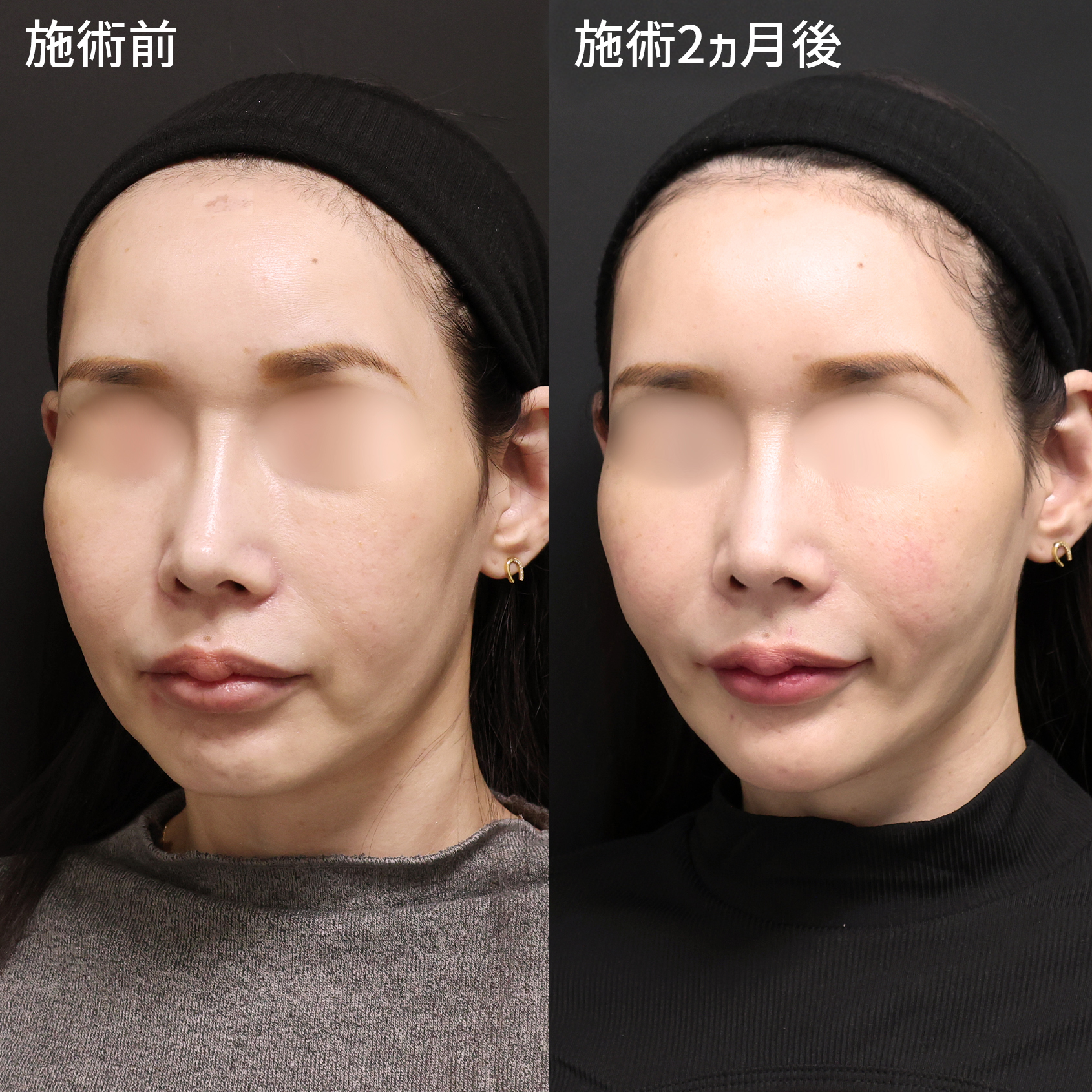 TAC式 ツヤ肌コラーゲンリフト®/ジョールファット除去/小顔整形｜パーフェクトフェイスラインの症例写真 施術前後 