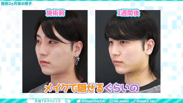 術前と術後1週間後の比較画像