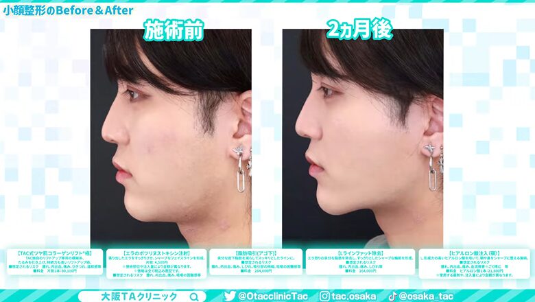 術後のビフォーアフター比較